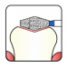 Osung Crown Posterior/ Occlusal Reduction Double Conical FG Shank 037-33M1 (038 811 033) Medium Grit Diamond Bur (811-033M) 5/PK